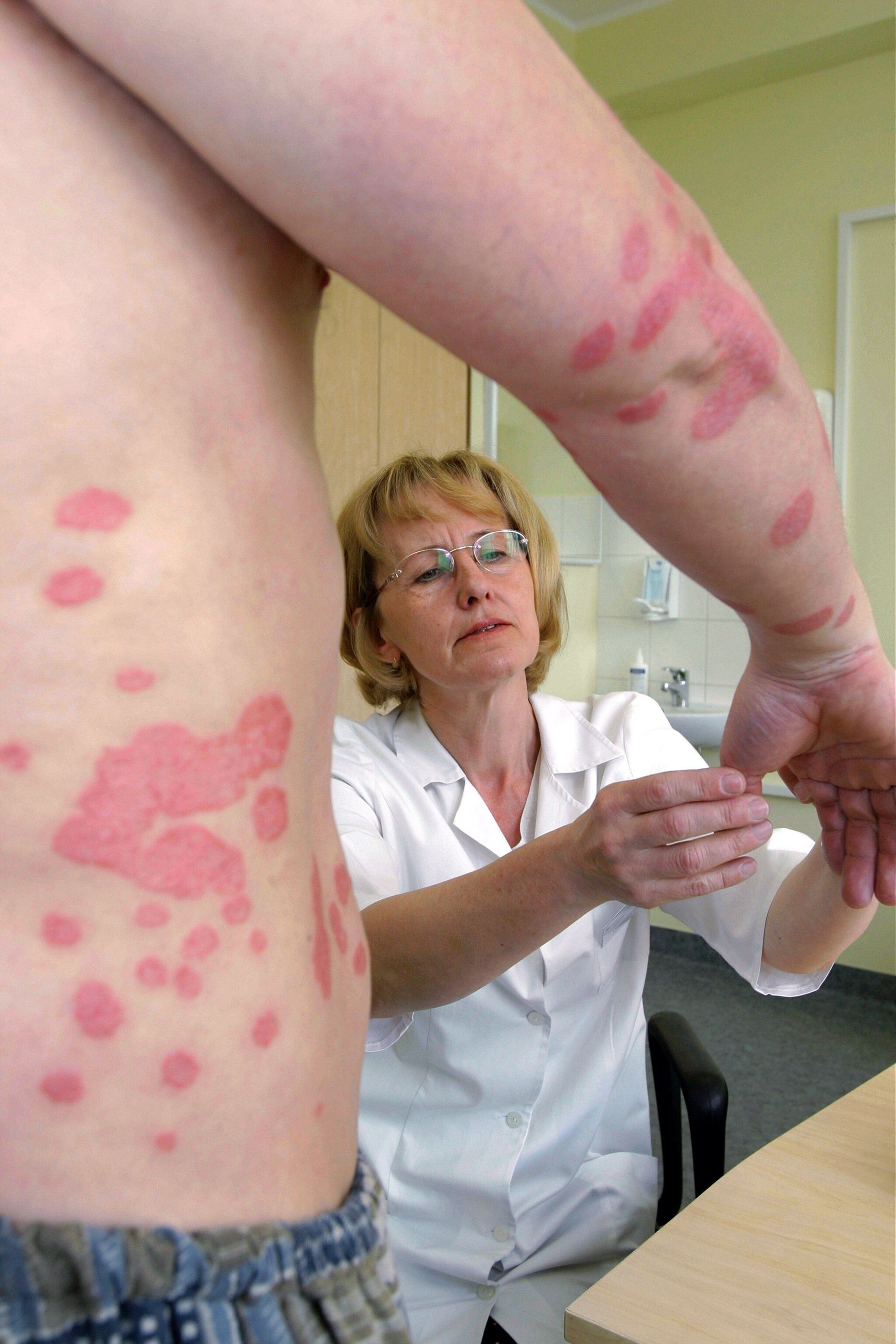 Psoriaasiga patsient.