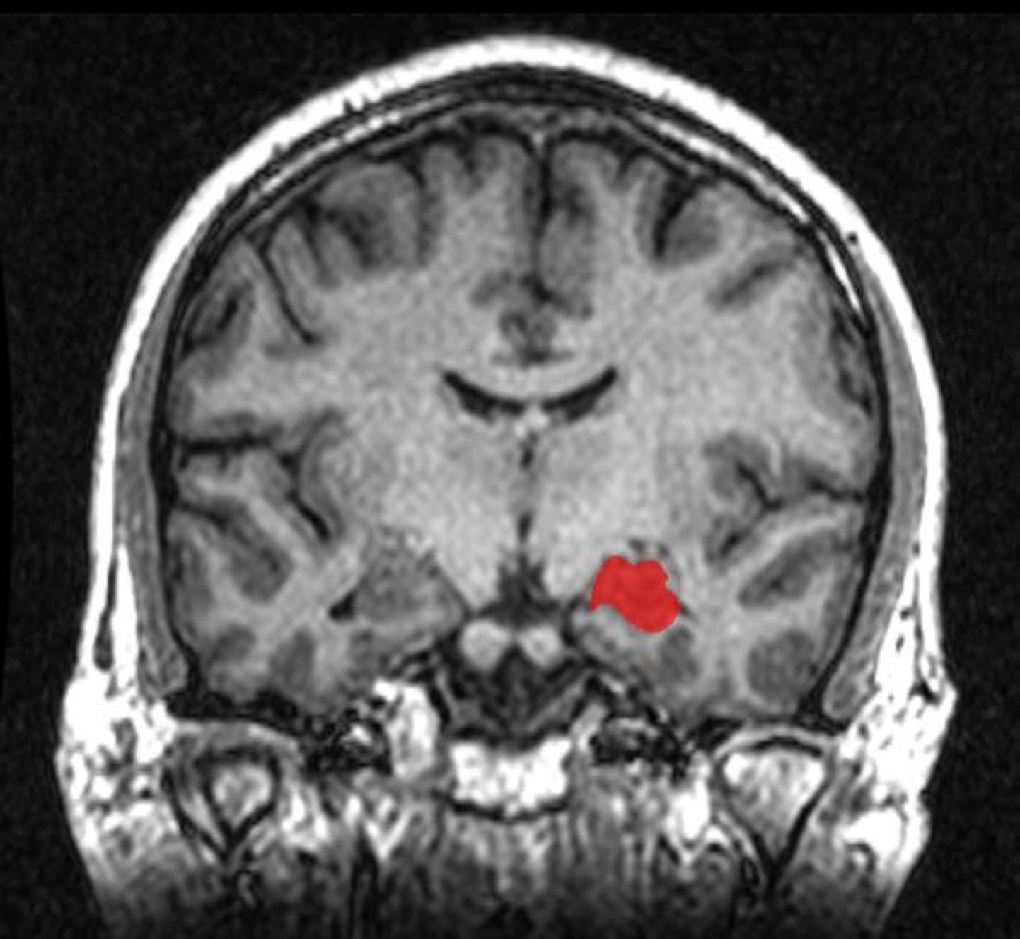 Hippokampuse asukoht ajus (punasega)