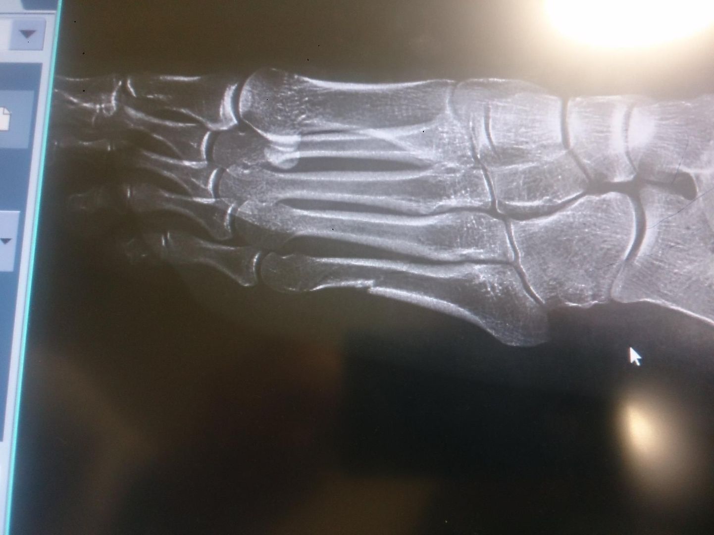 Justyna Kowalczyk avaldas Facebookis röntgenpildi oma vasakust jalast.