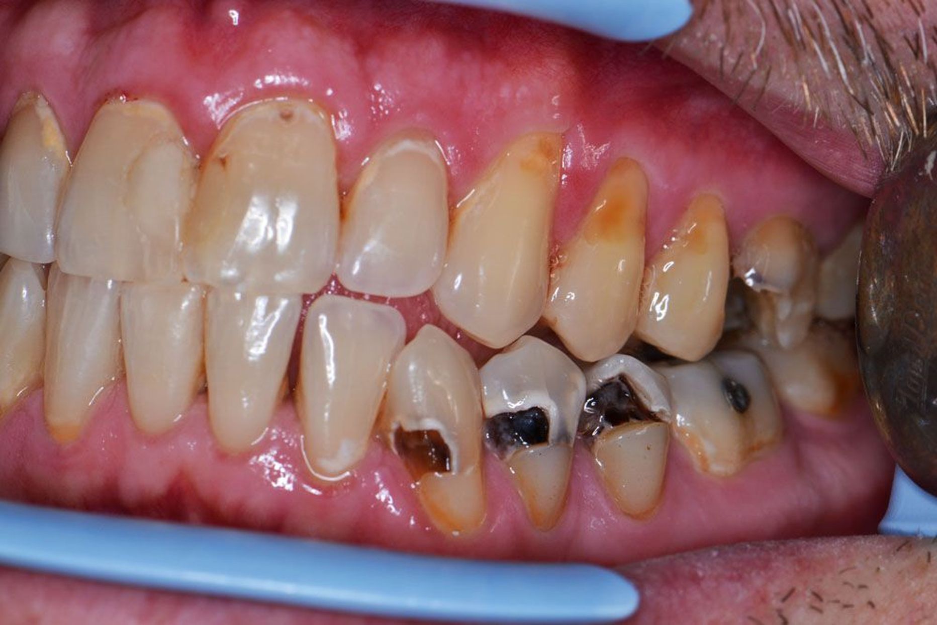 Coca-Cola-sõltlase ülalõua hammaste kaeltel on näha happesöövituse tagajärjed, alalõua hammastel on tüüpiline kaariesekahjustus, mis on hambakroonid seest õõnsaks määndanud.