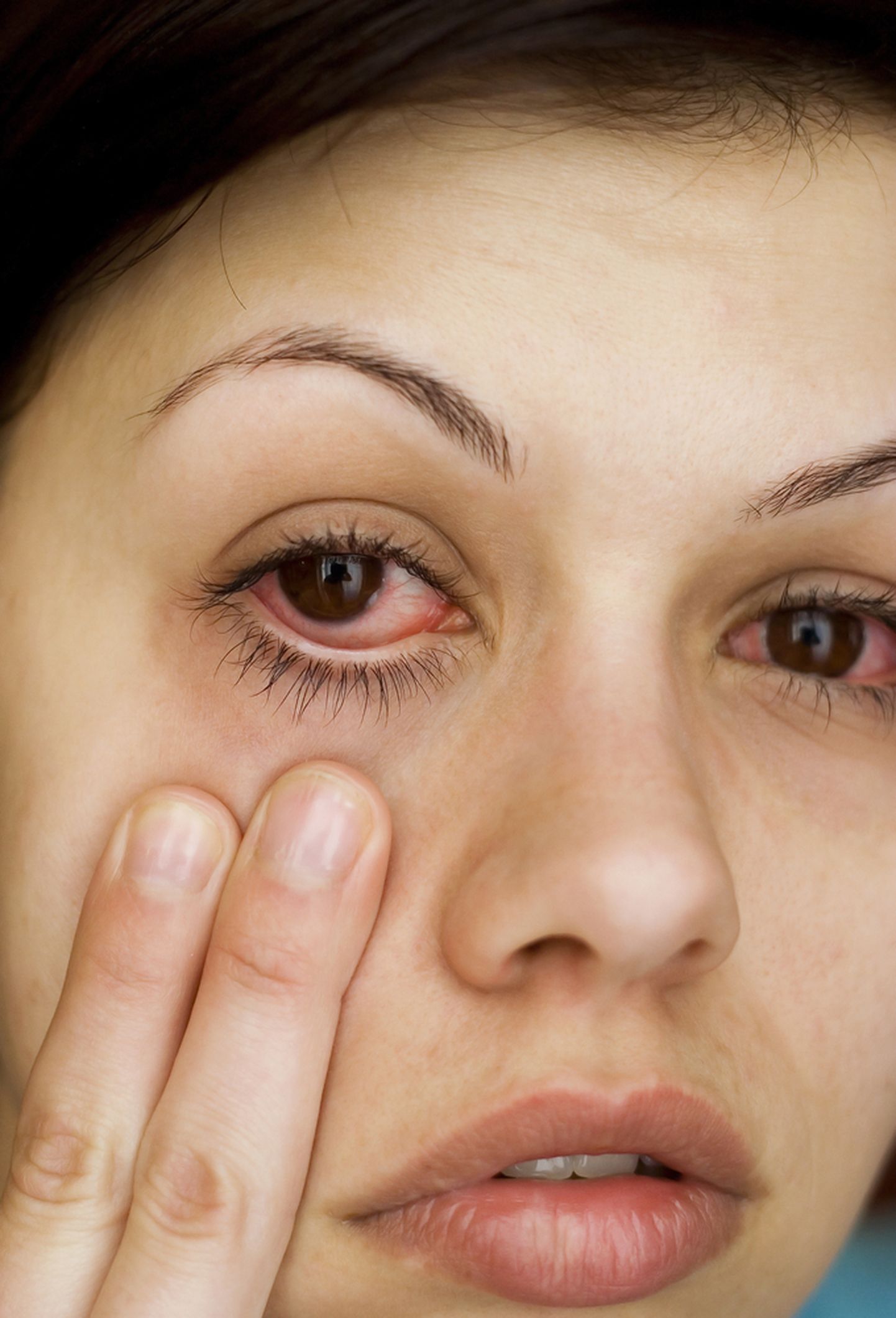 Silma limaskesta põletik: sümptomid ja ravi