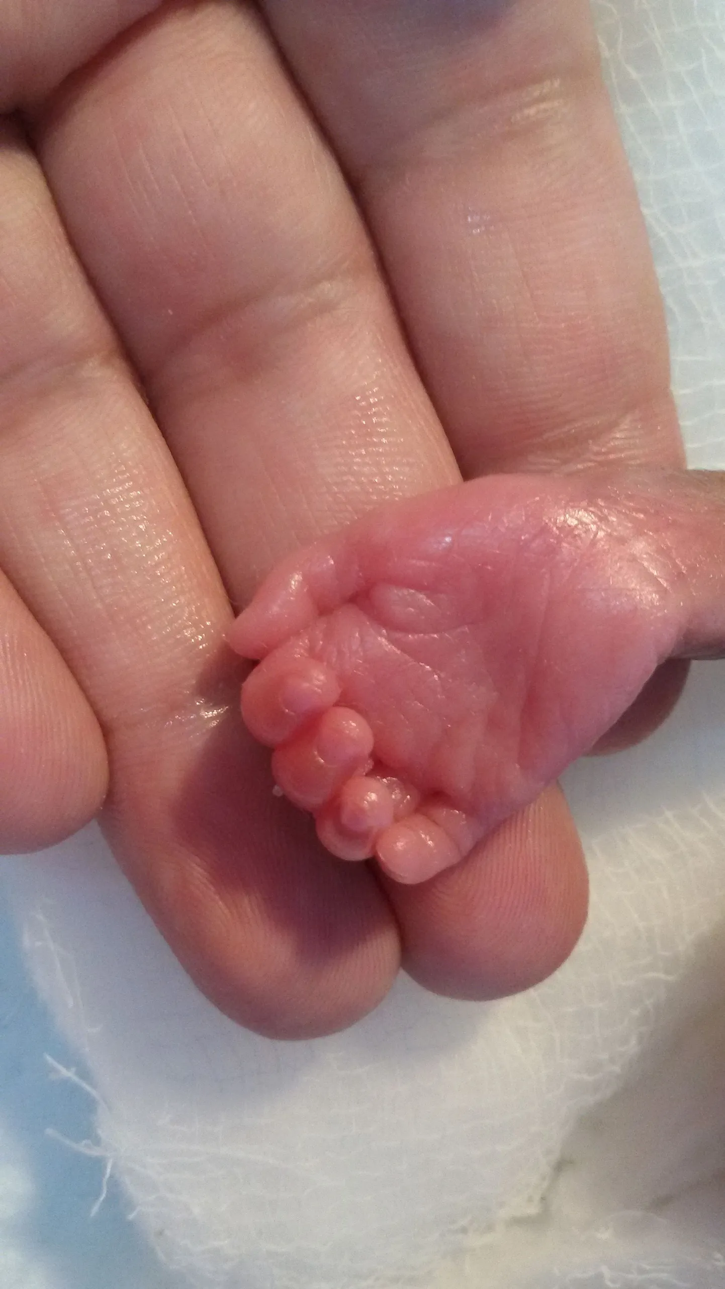 Peopesasuurune 28. rasedusnädalal sündinud beebi.