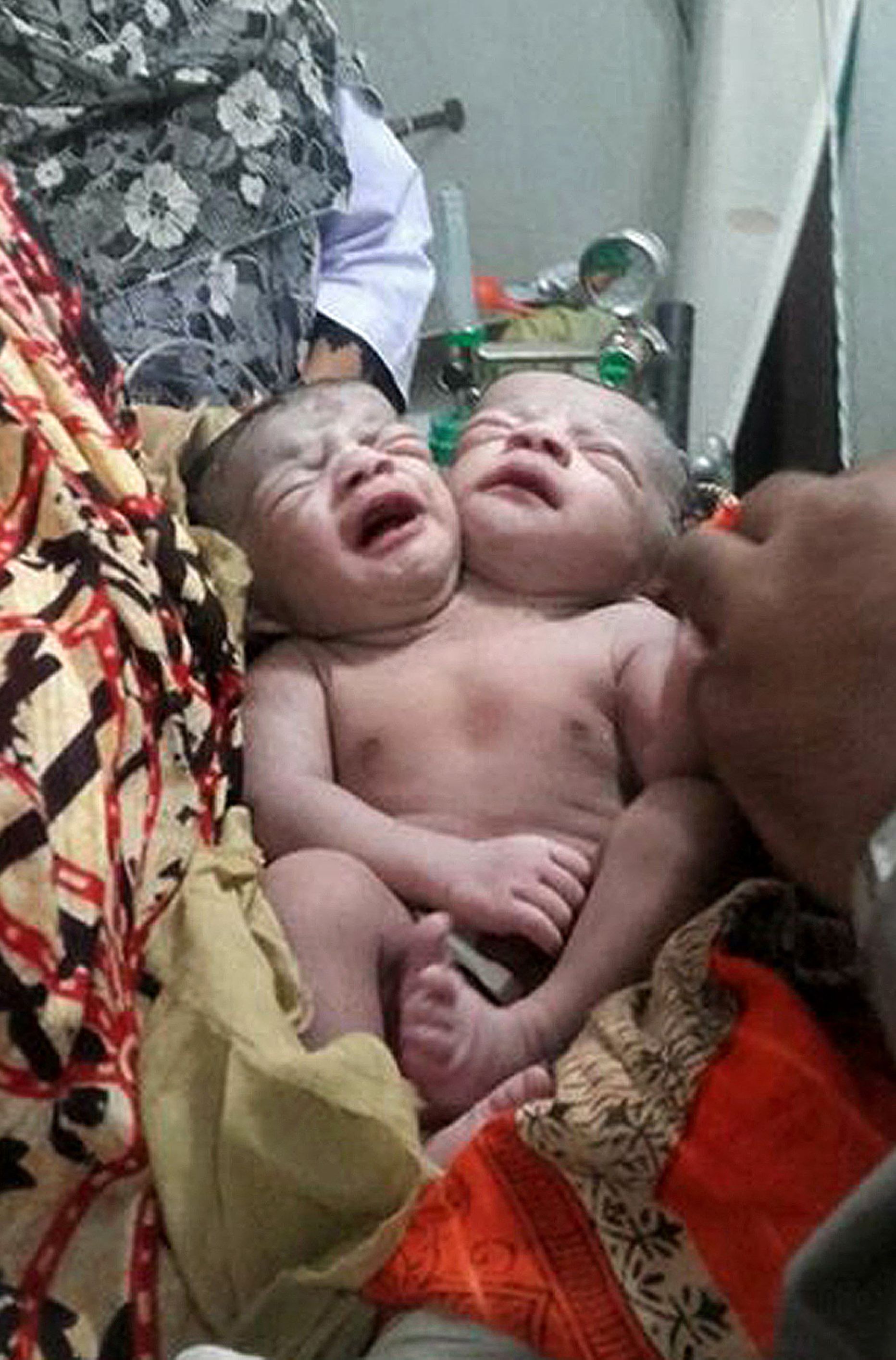 Bangladeshis sündis kahe peaga laps