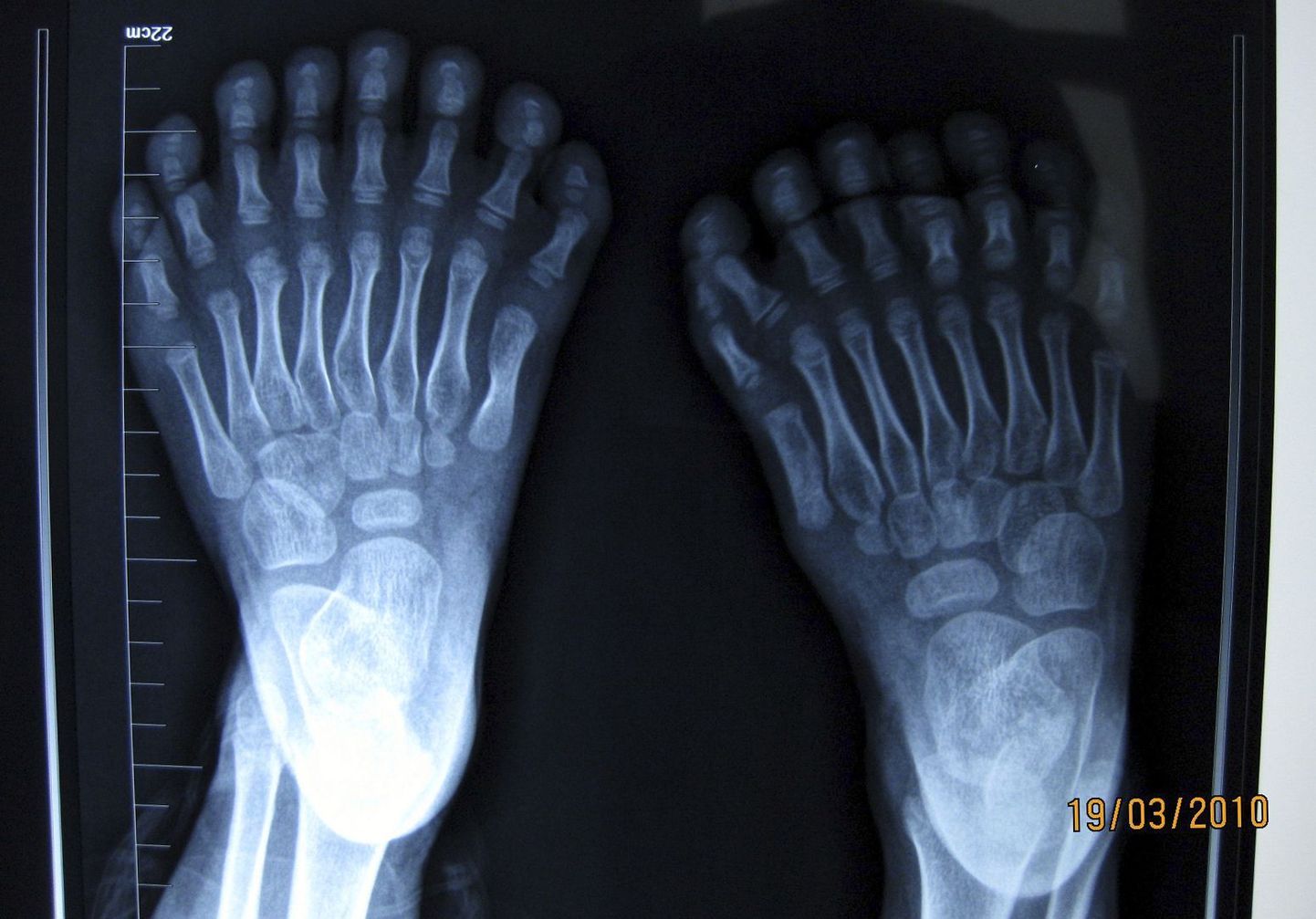 Röntgepilt 16 varbaga jalgadest