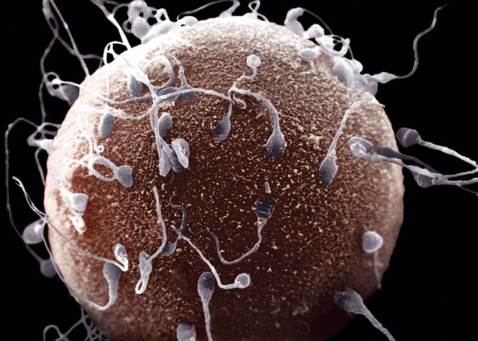 Азооспермия. Почему отсутствуют сперматозоиды? Лечение