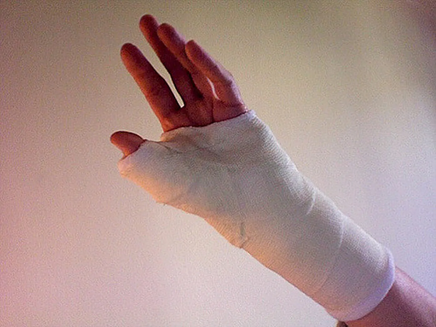 Broken pinky finger. К чему снятся отрубленные руки. Сонник палец сломали. Перелом пальца кисти гипсование. Указательный палец во сне.