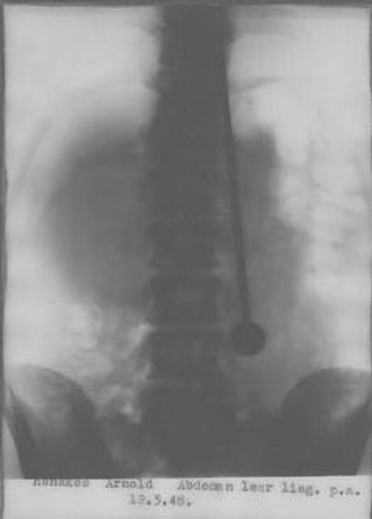 Röntgenpilt Mirin Dajo kehast, mille on läbistanud mõõk