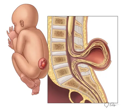 Spina bifida.