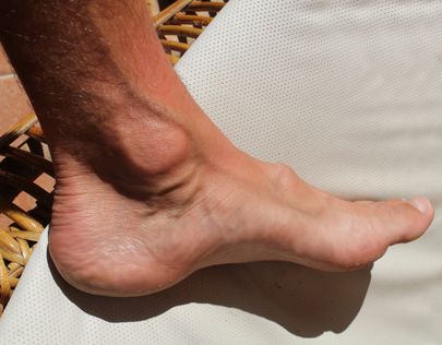 Suure varba kõverdumine ehk jalanukk on turse või kühm suure varba liigese välisküljel. Probleemi põhjustaja on suure varba kaldumine teise varba suunas.