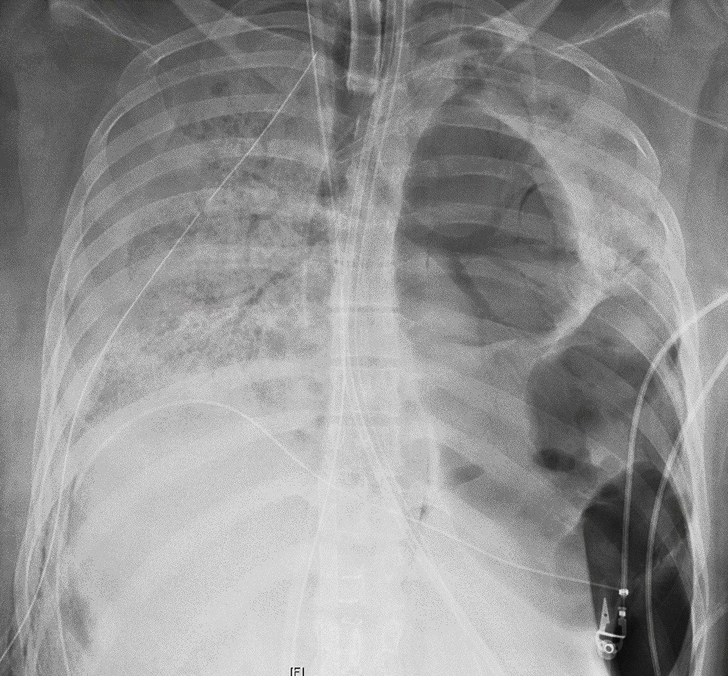 Röntgenülesvõte Covid-19 patsiendi kahjustunud kopsudest enne siirdamist.