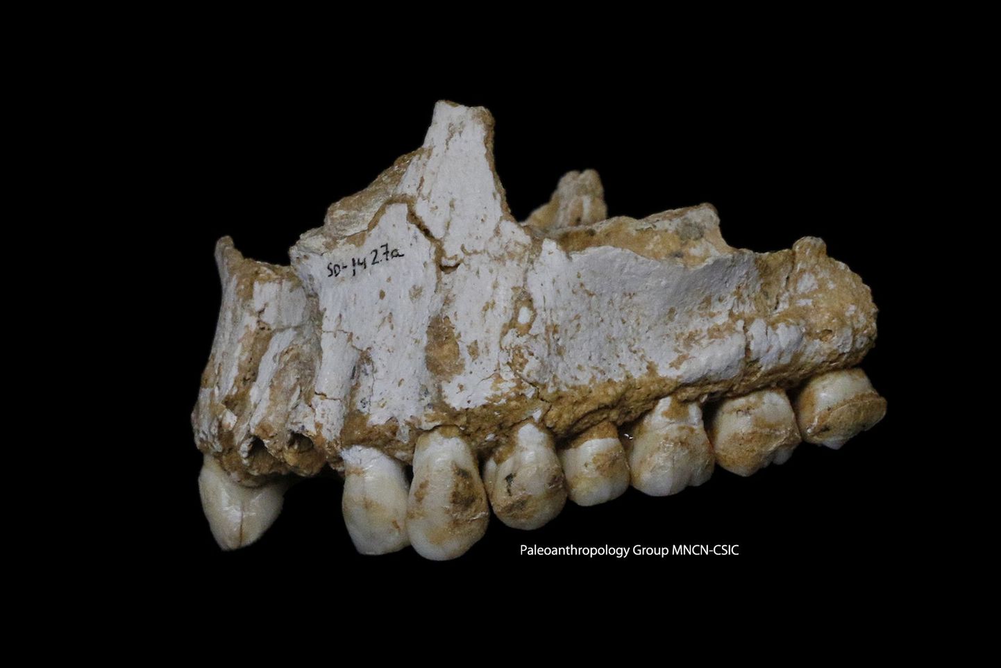 El Sidroni koopast leitud ülaluu: hambakatust on näha, et see isend pidi sööma paplikoort, mis toimis kui aspiriin, ja ka antibiootilise mõjuga Penicillum-seent.