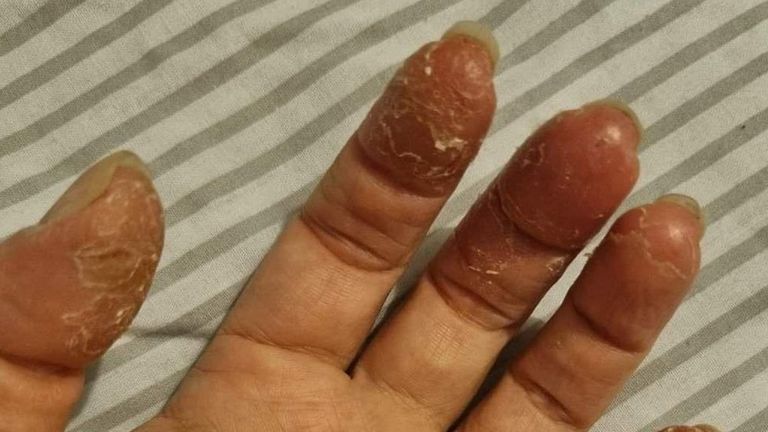 В некоторых случаях гель может вызвать сильное шелушение кожи на пальцах. От этого могут страдать и мастеры маникюра в салонах, особенно, если они не пользуются специальными перчатками