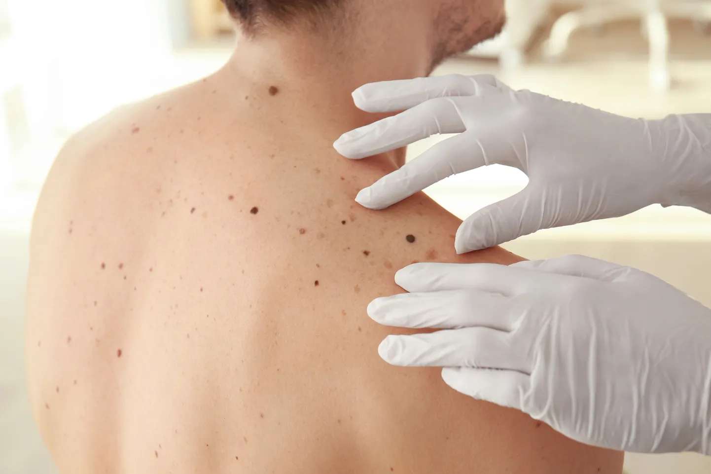 Dermatoloog nahka kontrollimas - sünnimärgi kontroll on vajalik siis, kui sünnimärk on suurenenud, kuju muutnud, hiljuti tekkinud, või veritseb ja sügeleb.