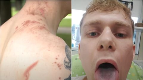 VIDEO ⟩ Ārsti to sauc par brīnumu: Āgenskalnā vīrietis izdzīvo pēc zibens spēriena