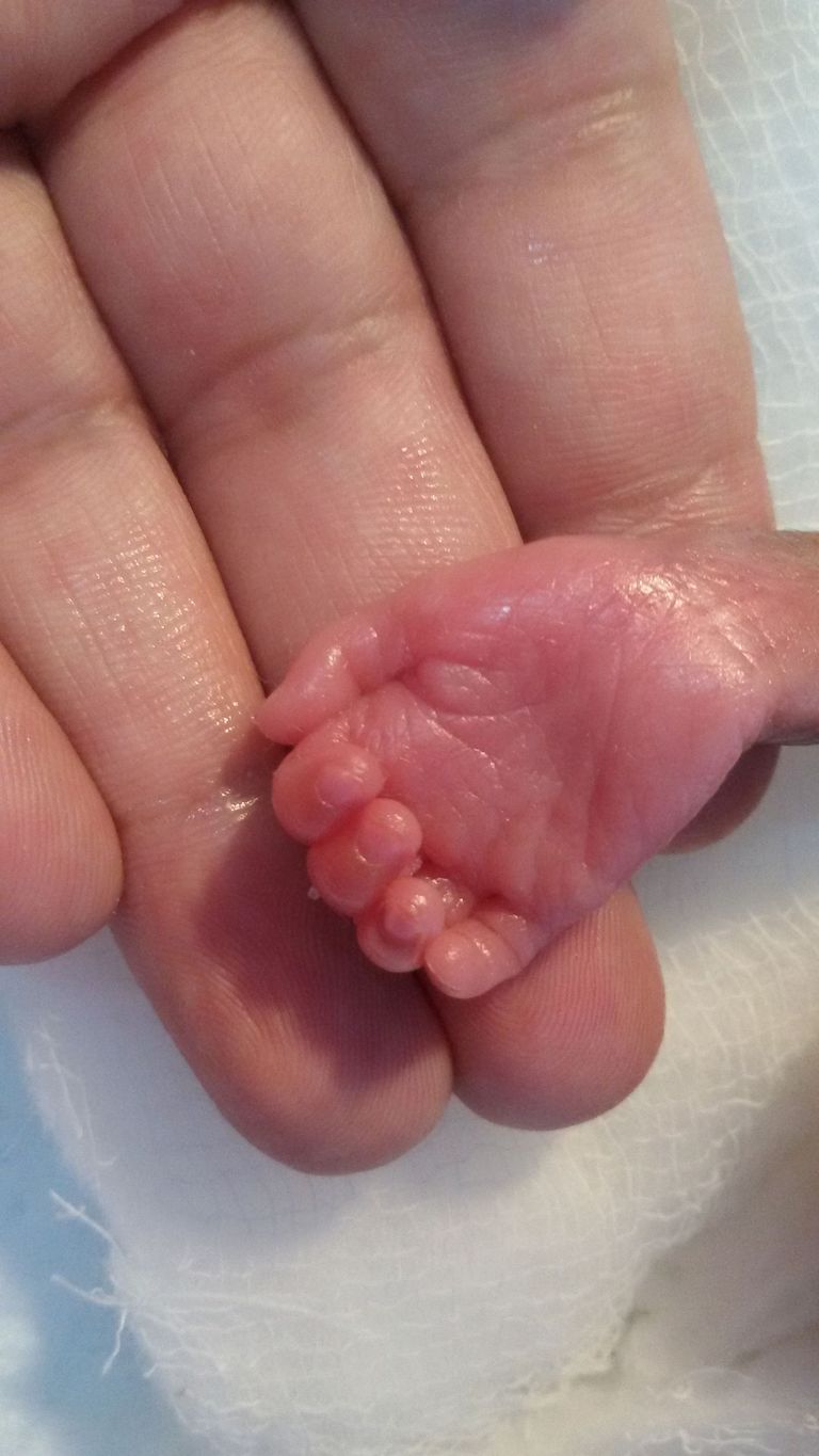 28. rasedusnädalal sündinud beebi käsi. Tema silmad, kopsud ja nahk polnud veel välja arenenud, kui ta sai noorimaks südameoperatsiooni patsiendiks