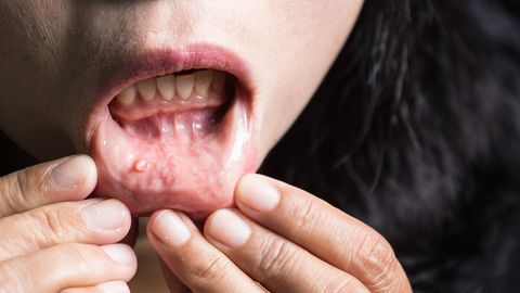 Viis soovitust, mis aitavad suuõõnevähki eemale hoida