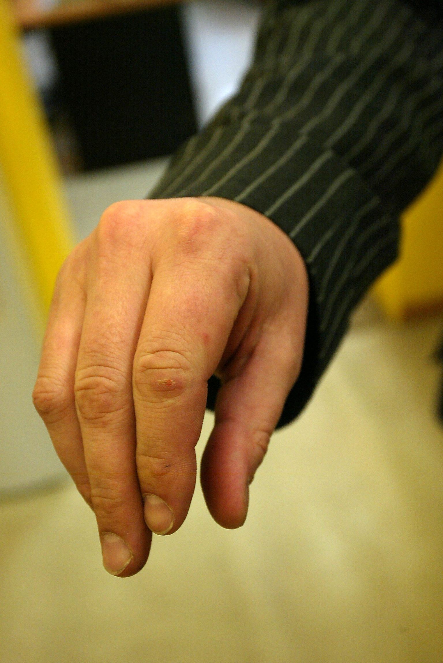 Sõrmede surisemine on seotud kaelalihastega.