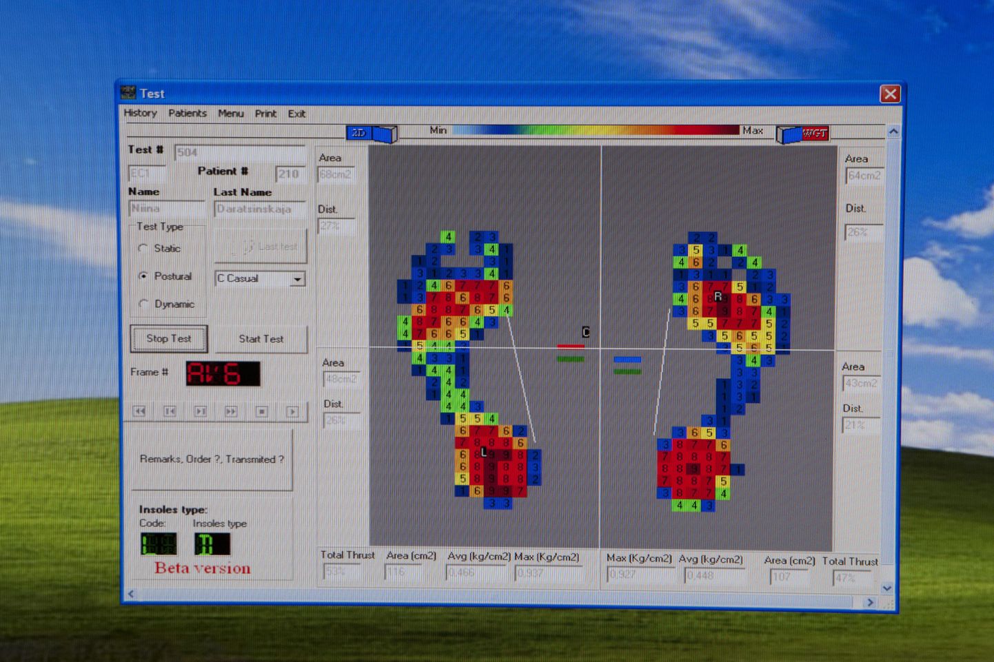 Датчики специального прибора - подометра передают на комьютер информацию о распределении давления на обеих стопах. На экране она преобразуется в картинку из разноцветных кубиков.
