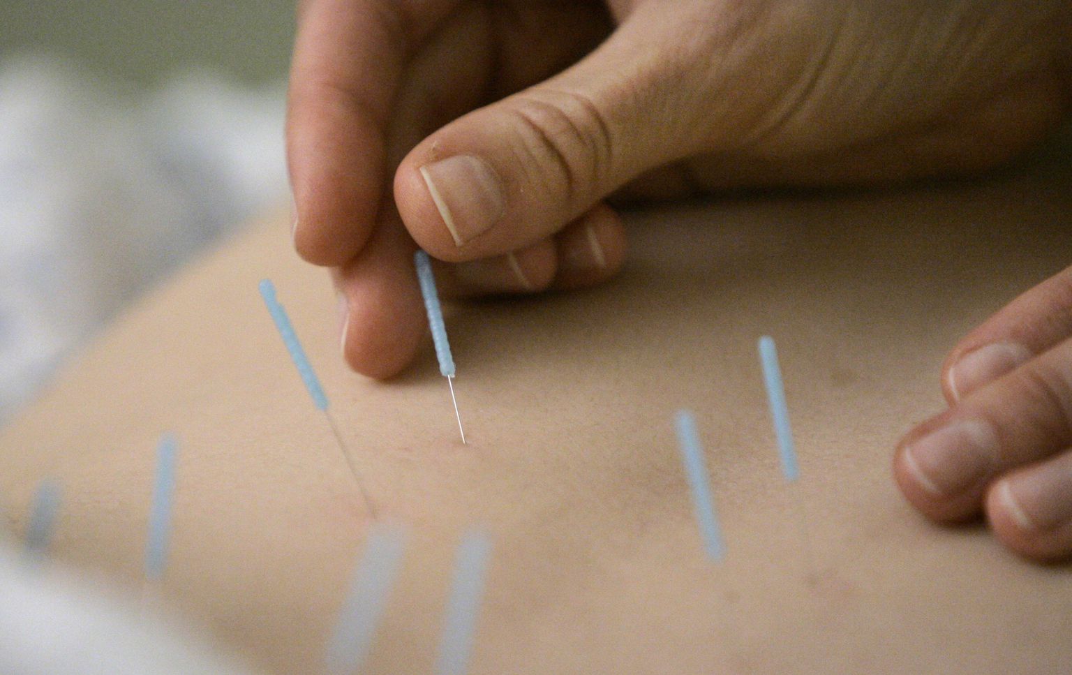 Akupunktuur ehk nõelravi