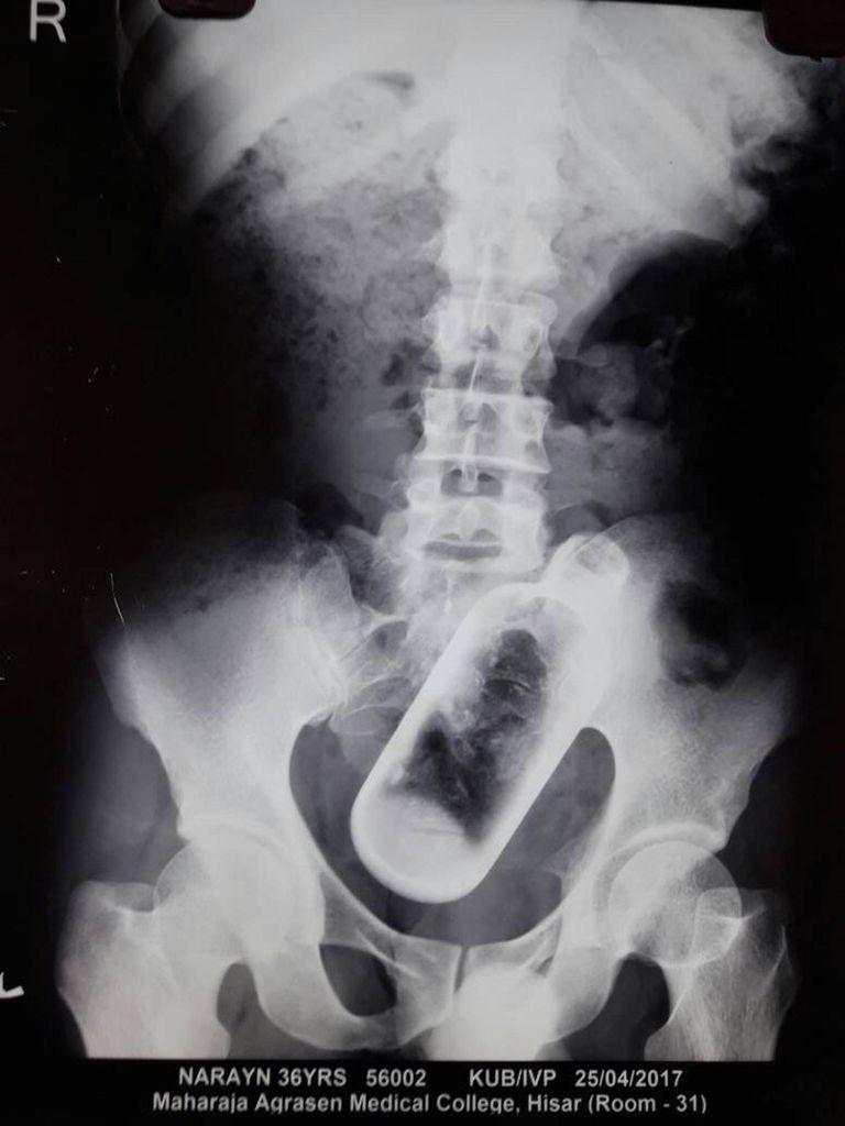 Klaaspudel mehe kõhus röntgenkiirte all.
