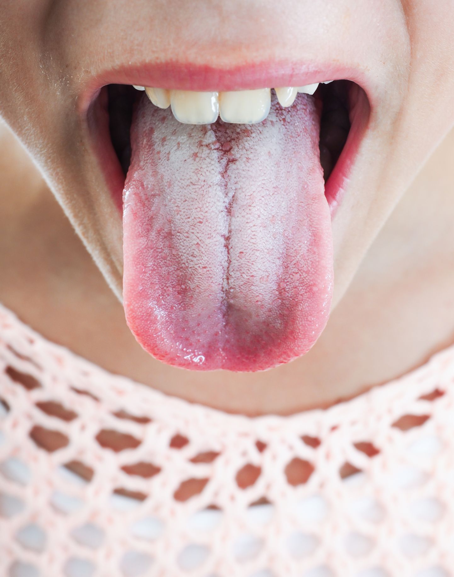 Valge katt keelel võib viidata B-vitamiini puudusele.