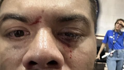 VIDEO ⟩ UFC matš lõppes vastiku vigastusega: tundsin, et minu silmamuna rebiti välja