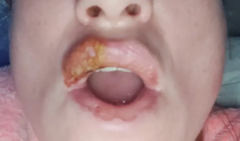 Katki kiskunud huul põhjustas palju valu.