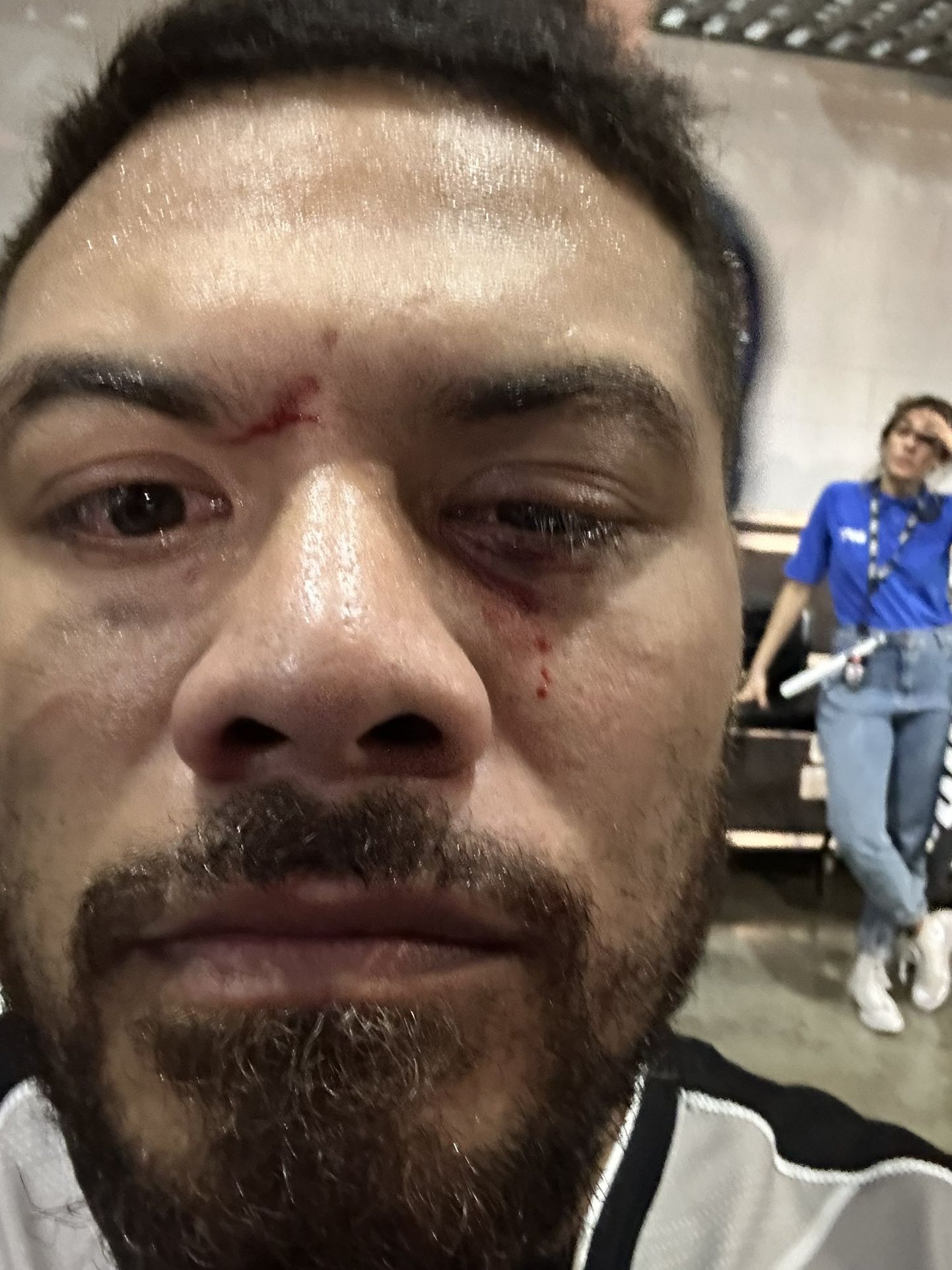 Justin Tafa näitas oma vigastatud silma.