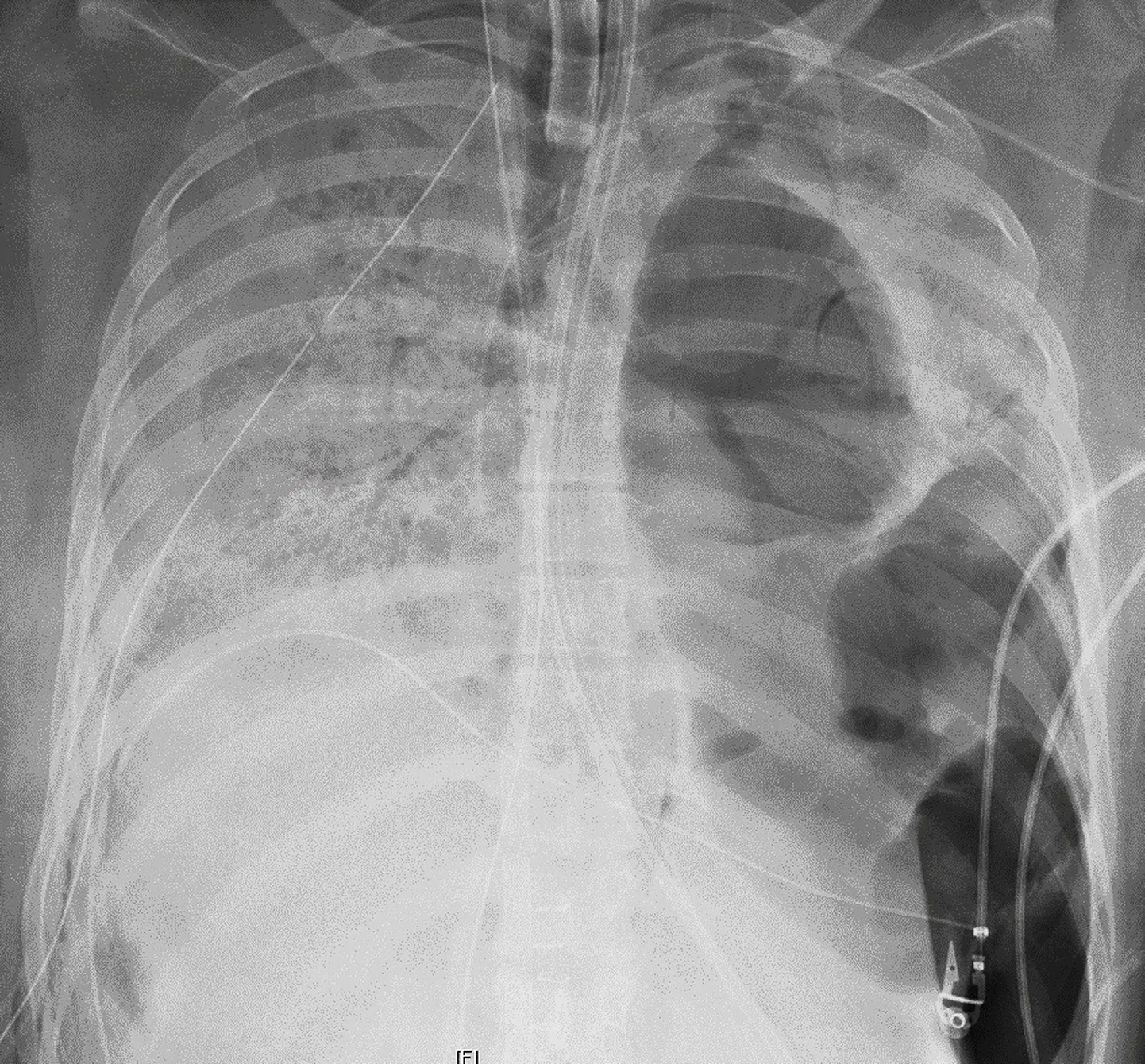 Röntgenülesvõte Covid-19 patsiendi kahjustunud kopsudest enne siirdamist.