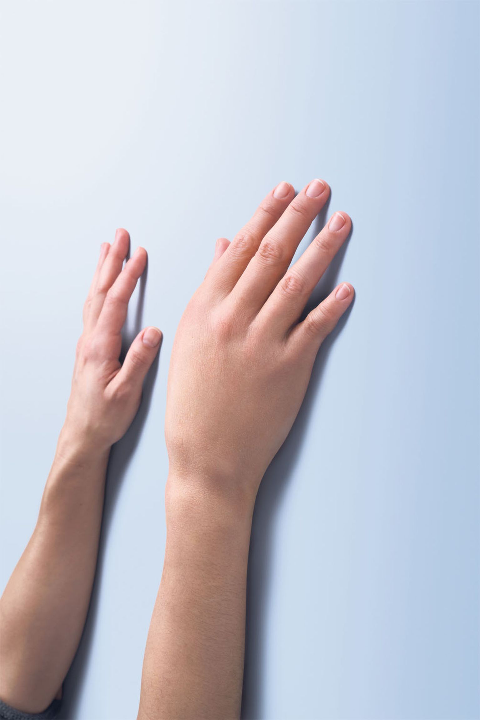 Наследственный ангионевротический отек (НАО) - редкое заболевание, основным симптомом которого являются отеки на лице, в гортани, в животе и по телу, часто путают с аллергией. На снимке отек руки, вызванный НАО.