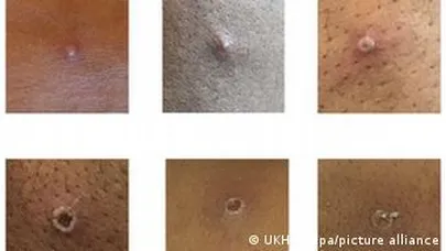 Повреждения на коже человека, заболевшего оспой обезьяны