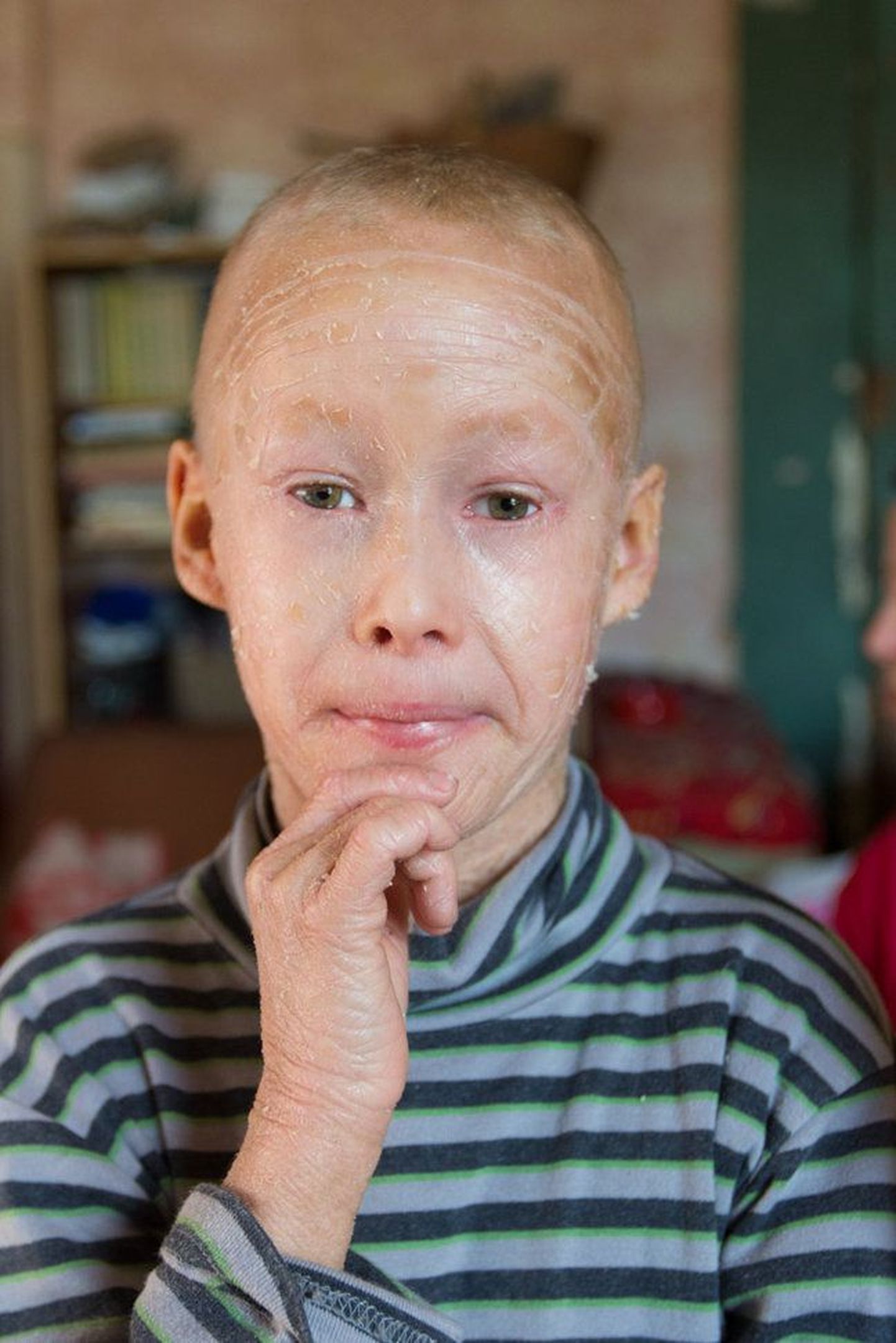 Восьмилетний Кайдо из Валгамаа, страдающий ихтиозом
