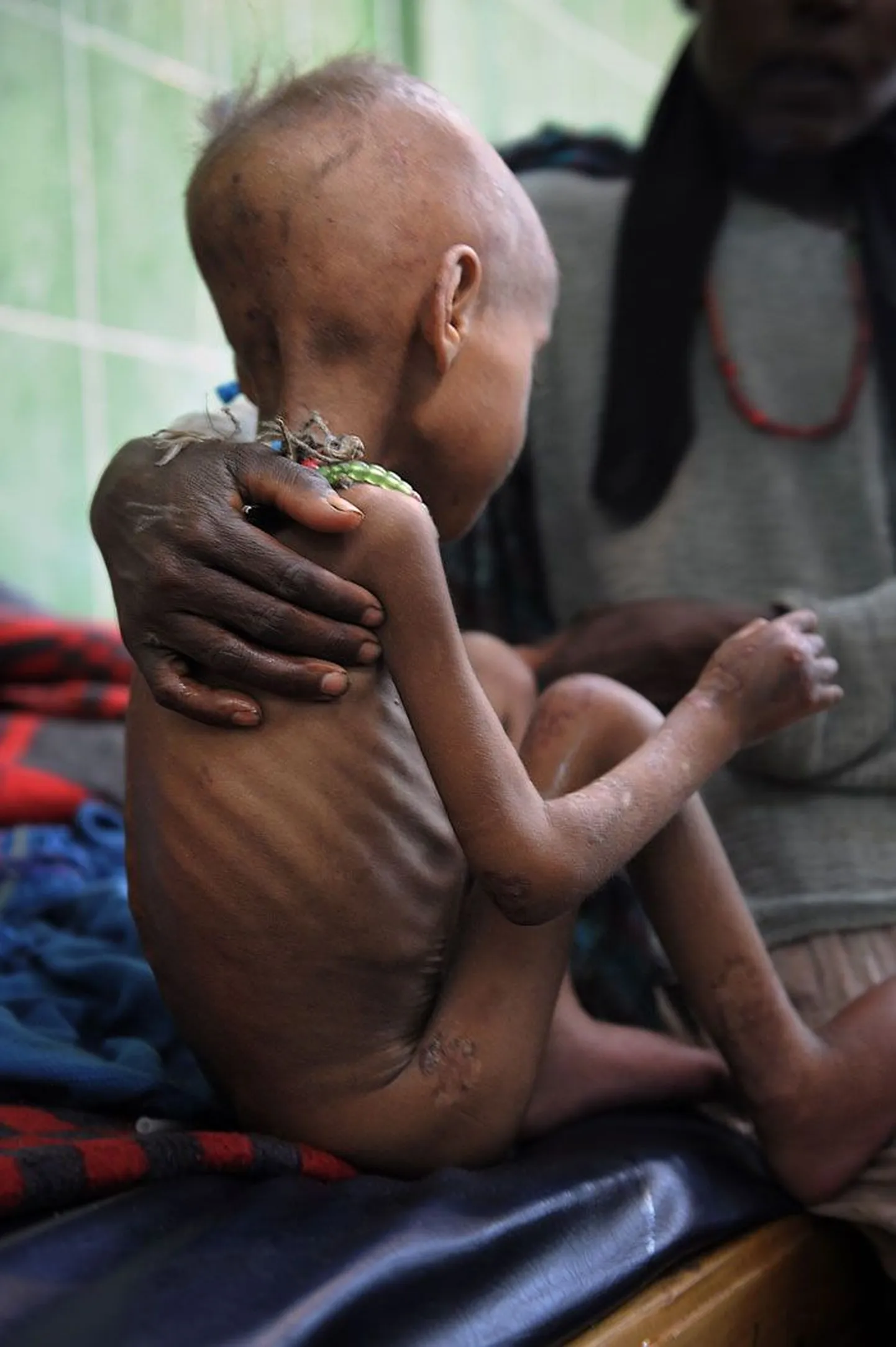 Nälgivaid lapsi leidub Etioopias tänapäevani. Pildil olev alatoidetud viieaastane tüdruk sattus Piirideta Arstide kliiniku intensiivraviosakonda 2008. aastal.