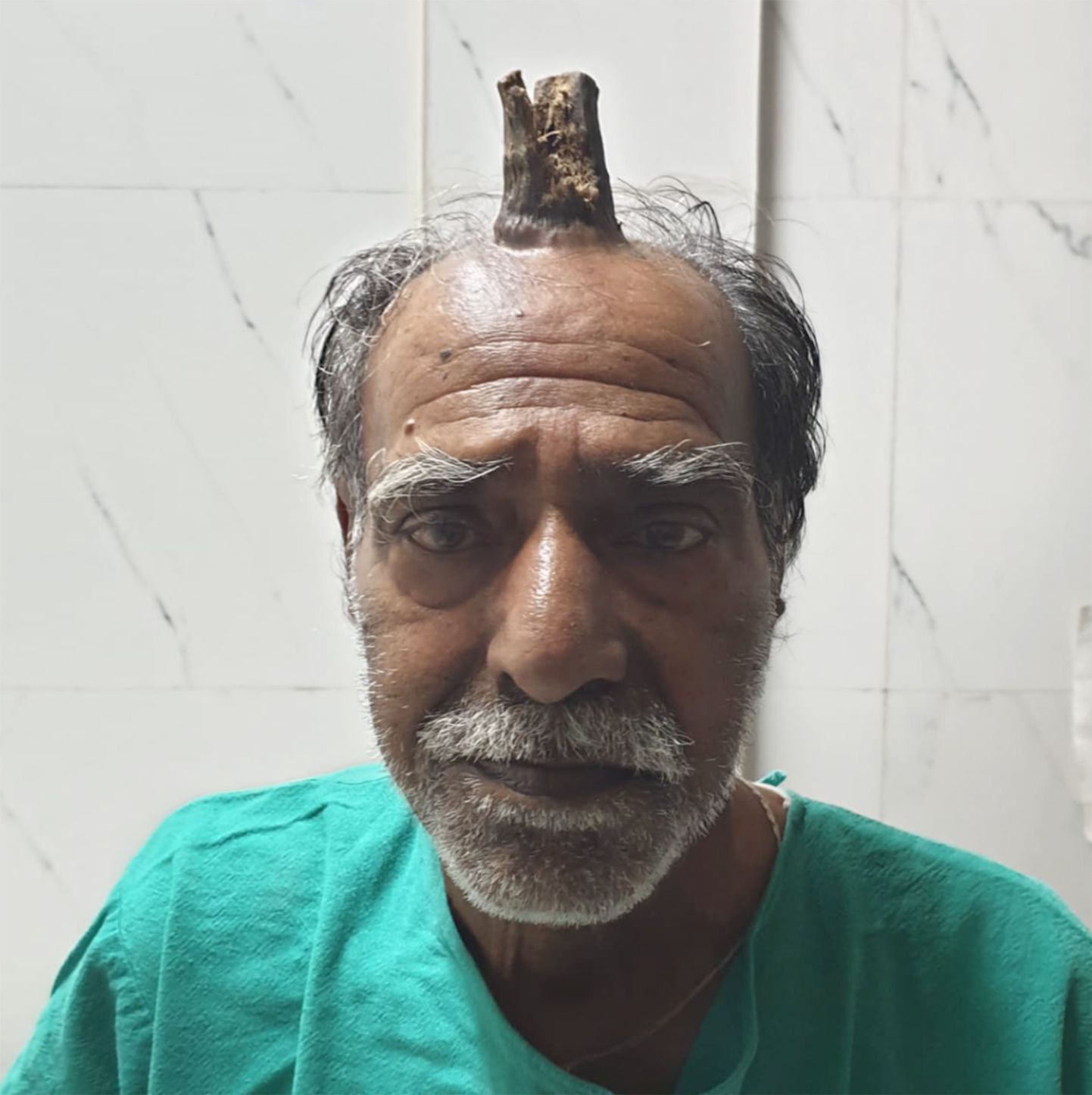 Фермеру из Индии удалили выросший посреди головы рог