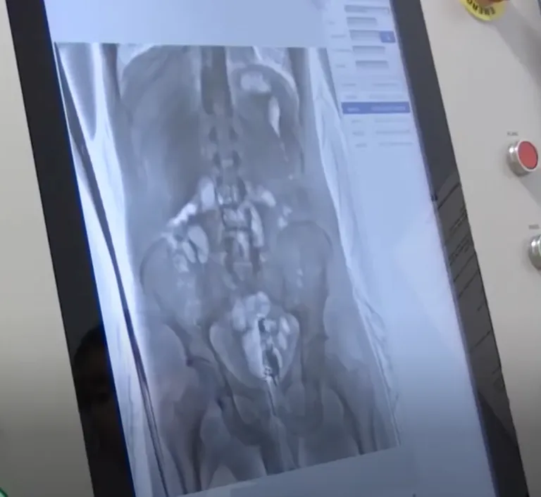 Röntgenülesvõte Zachary Bowlerist, kes peitis enda pärakusse üllatusmuna, mille ta kavatses vanglasse smugeldada.