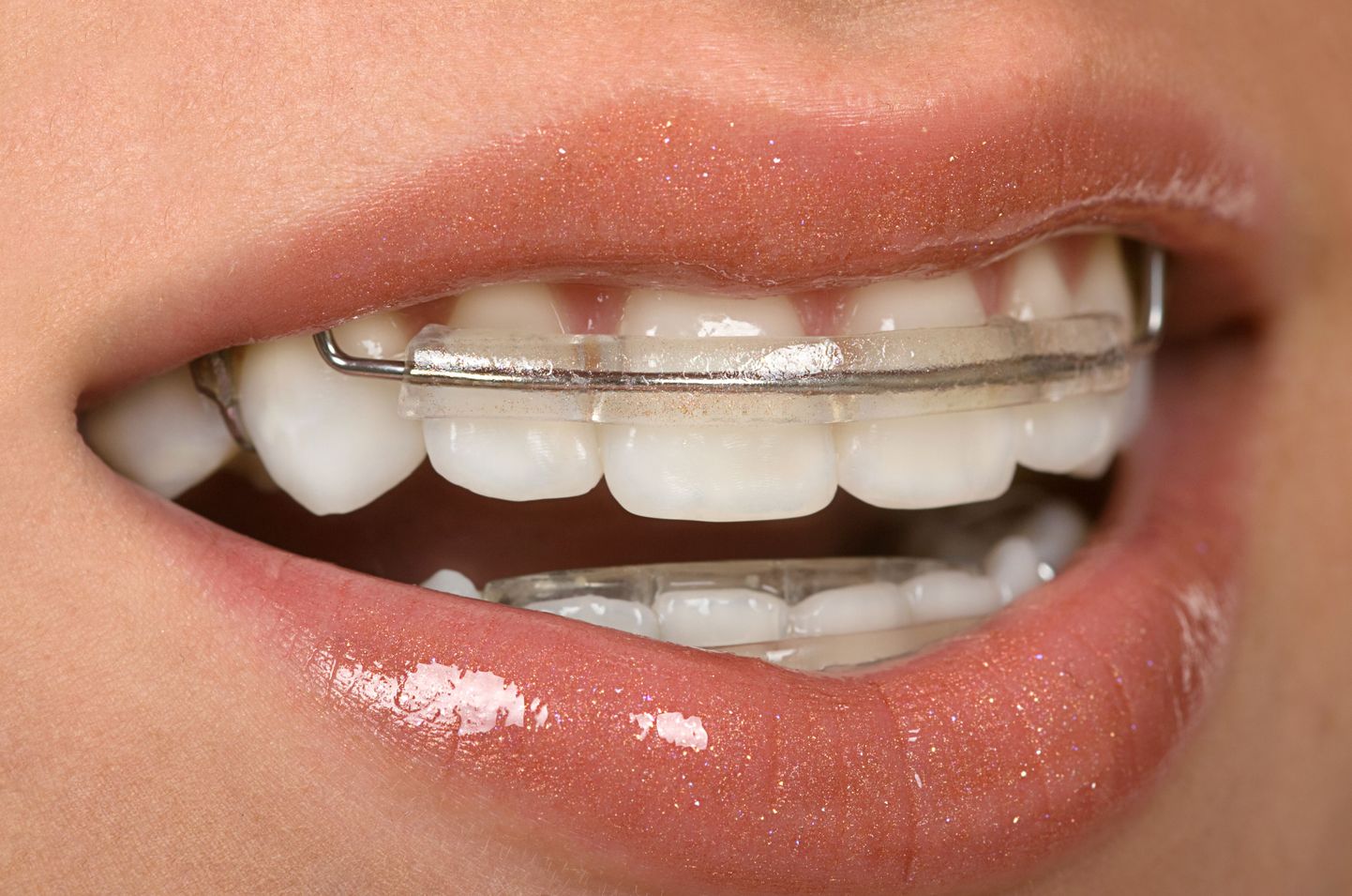 Ortodondis soovitavad peale hammaste korrigeerimist kanda äravõetavaid klambreid iga öö.