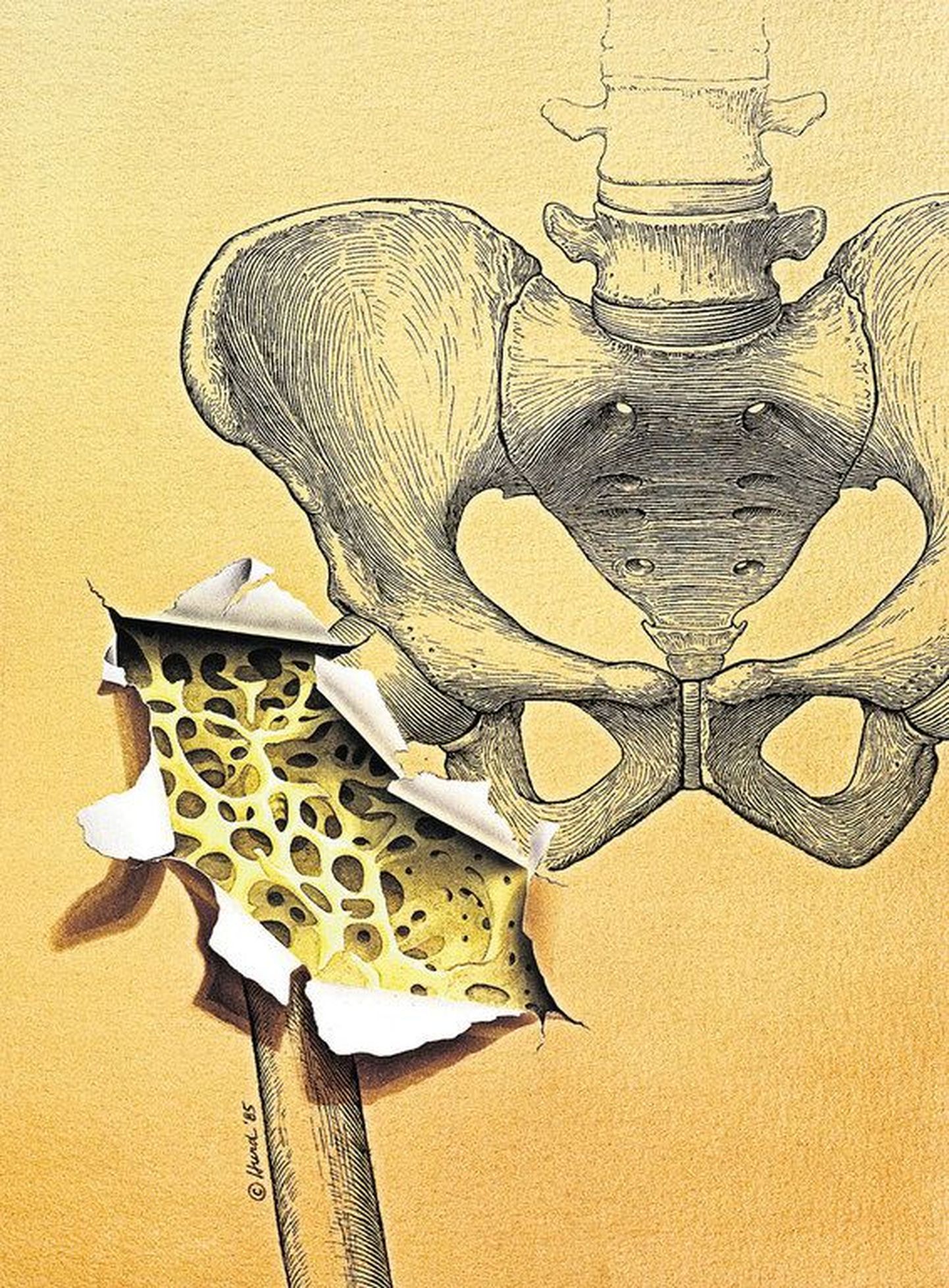 Osteoporoos muudab luud poorseks ja isegi väike trauma võib põhjustada selliste luude murru.