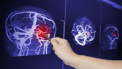 Stradiņa slimnīcas Neiroloģijas klīnika pretiestiem apbalvojumiem par izcilu insulta ārstēšanu