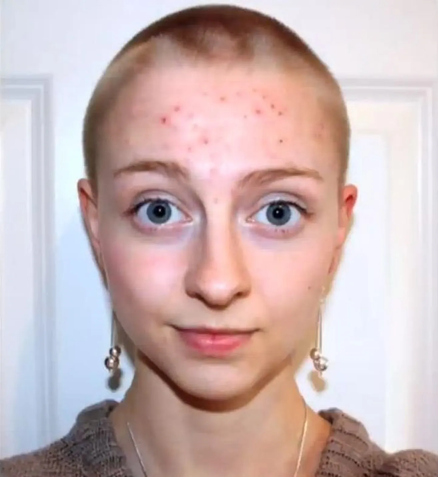Trihhotillomaania all kannatav naine katkus end kiilaks