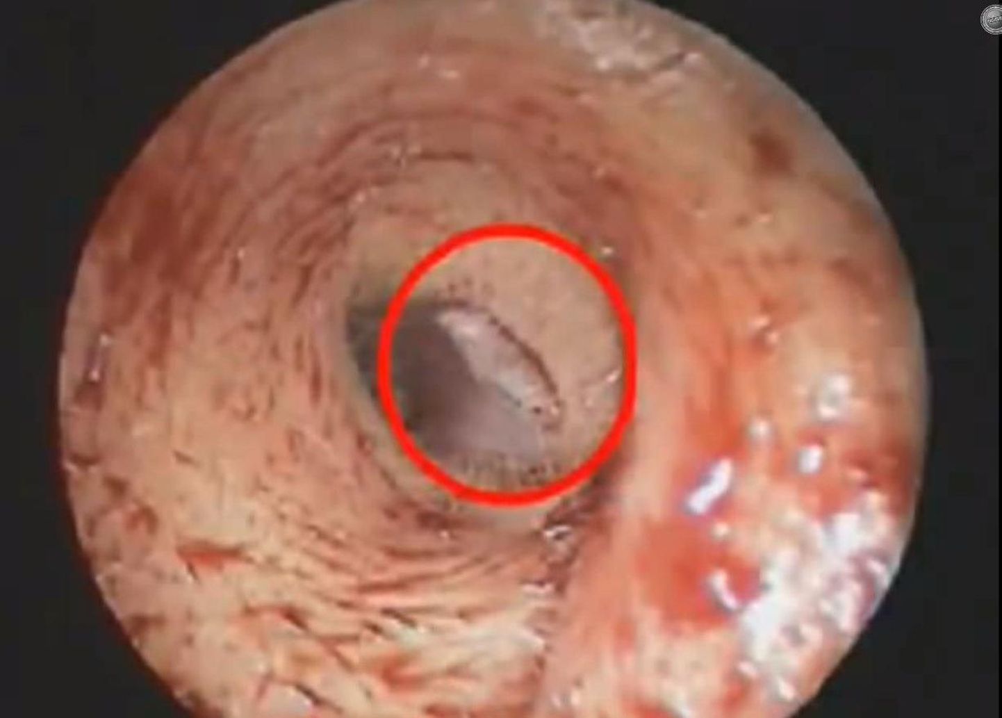 Taiwanlanna kõrvast leiti äädikakärbse vastne