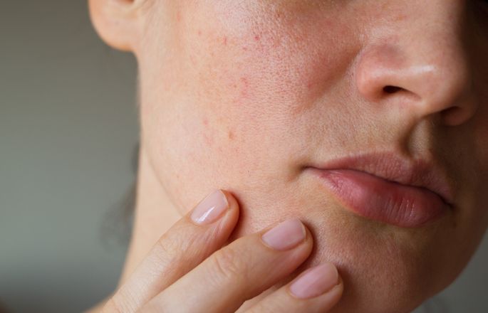 Шелушится кожа на лице: причины, советы, как избавиться, профилактика