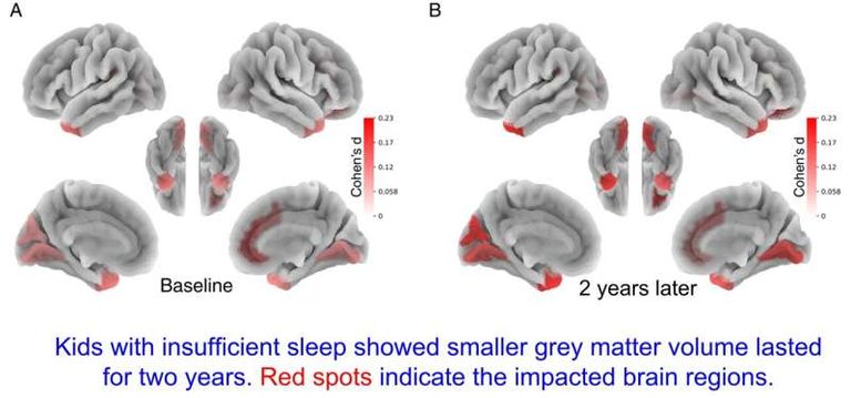 Piltidel on näha erinevusi hallaine mahus piisavalt magavate ja liiga vähese unega laste vahel. Mõõtmise hetkel tehtud tulemusi kajastab joonis A ja järeluuringu tulemused on näha joonisel B. 
Punased alad on struktuurid, mis vastutavad otsuste tegemise, impulsside kontrolli, mälu ja meeleolu reguleerimise eest.