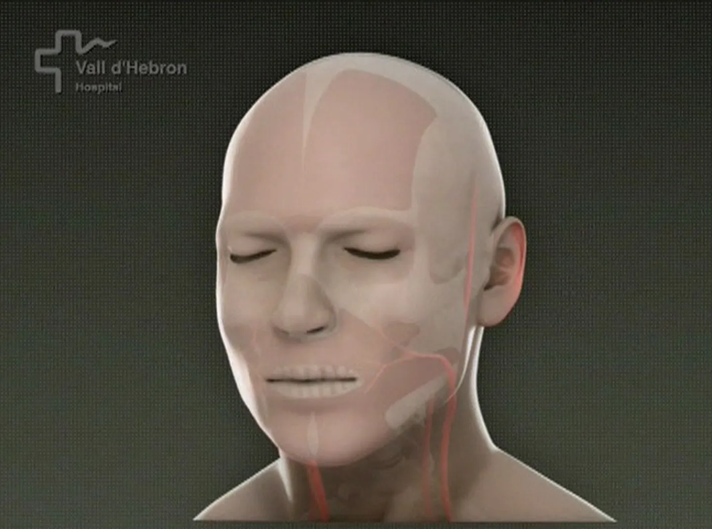 Схематичное изображение лица пациента после проведения операции по полной пересадки лицевых мышц.