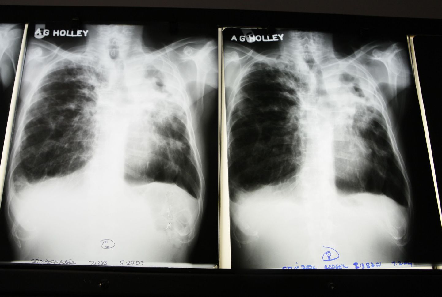 Рентгеновский снимок легких, пораженных мультирезистентным туберкулезом.