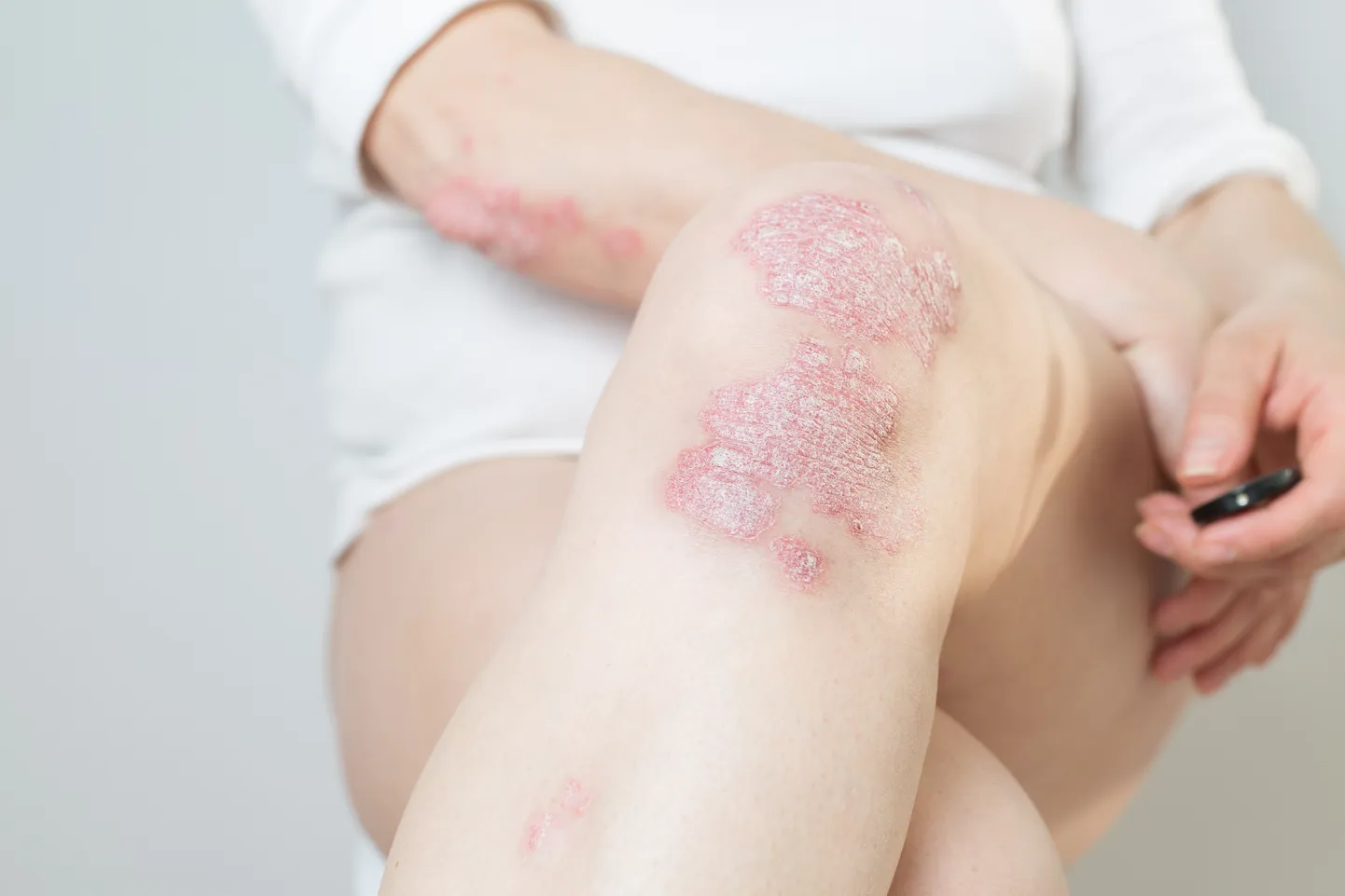 Psoriaas