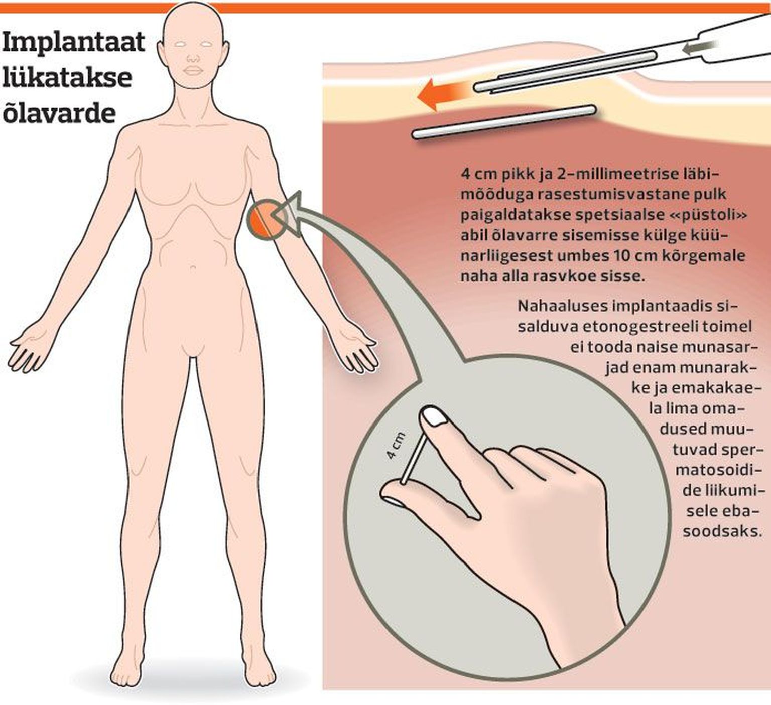 Rasestumisvastase implantaadi paigaldamine