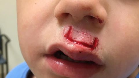 Опасные игры: спиннер серьезно поранил маленького мальчика