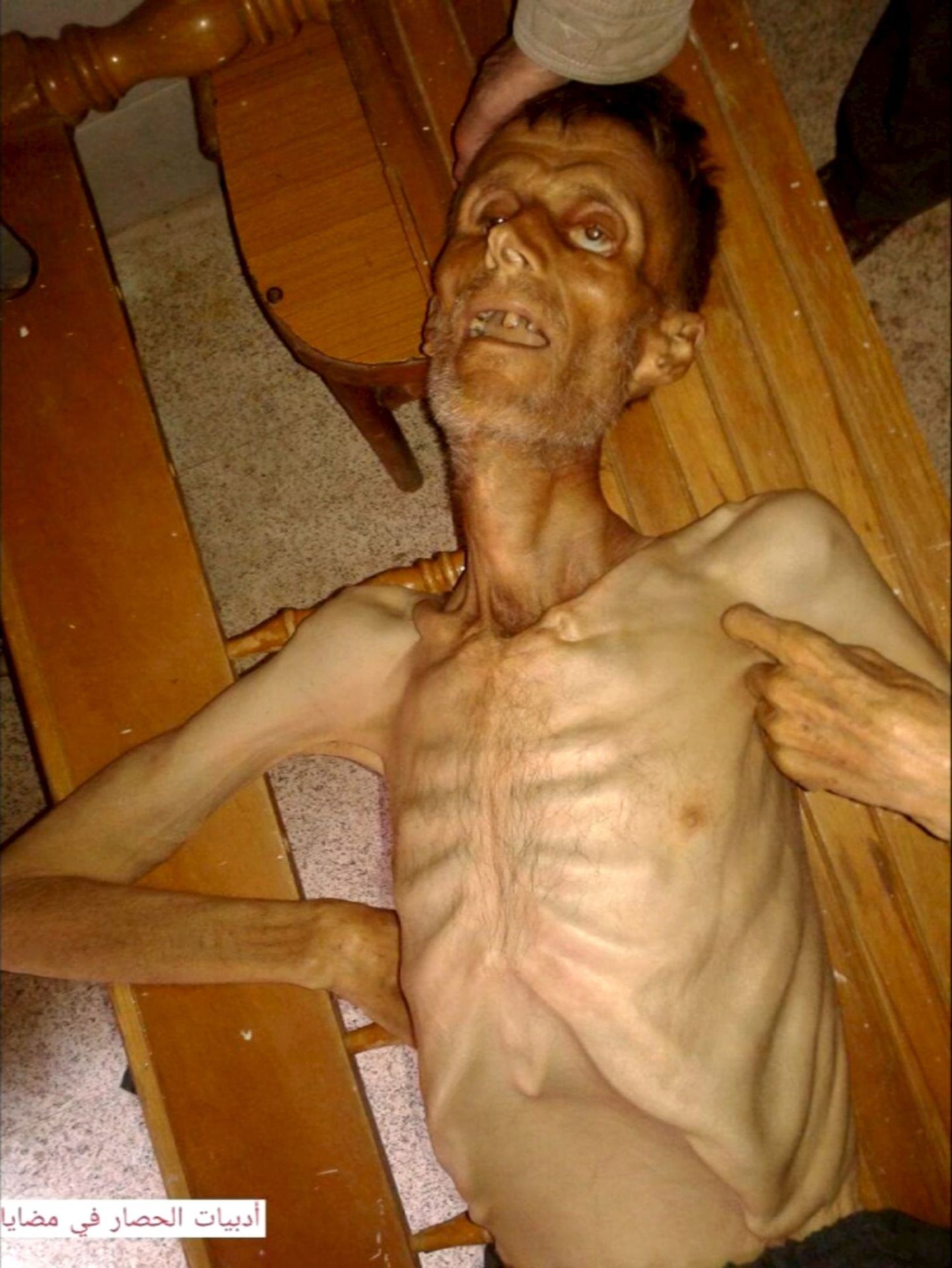 ÜROl on õnnestunud viia humanitaarabi Madayasse Süürias, kus samuti inimesed nälgisid. Fotol on nälginud mees Madayas.