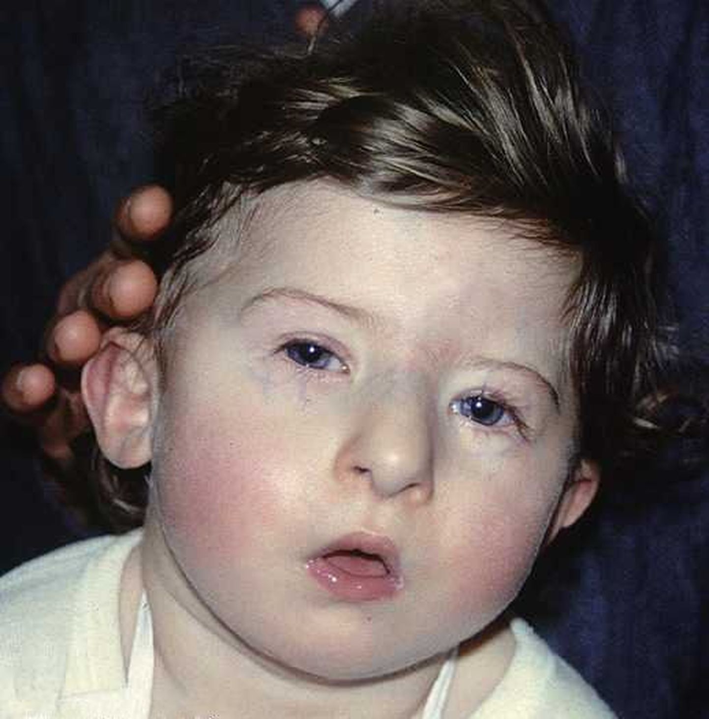22q11.2 ehk Di Georgi sündroomi põdev laps.