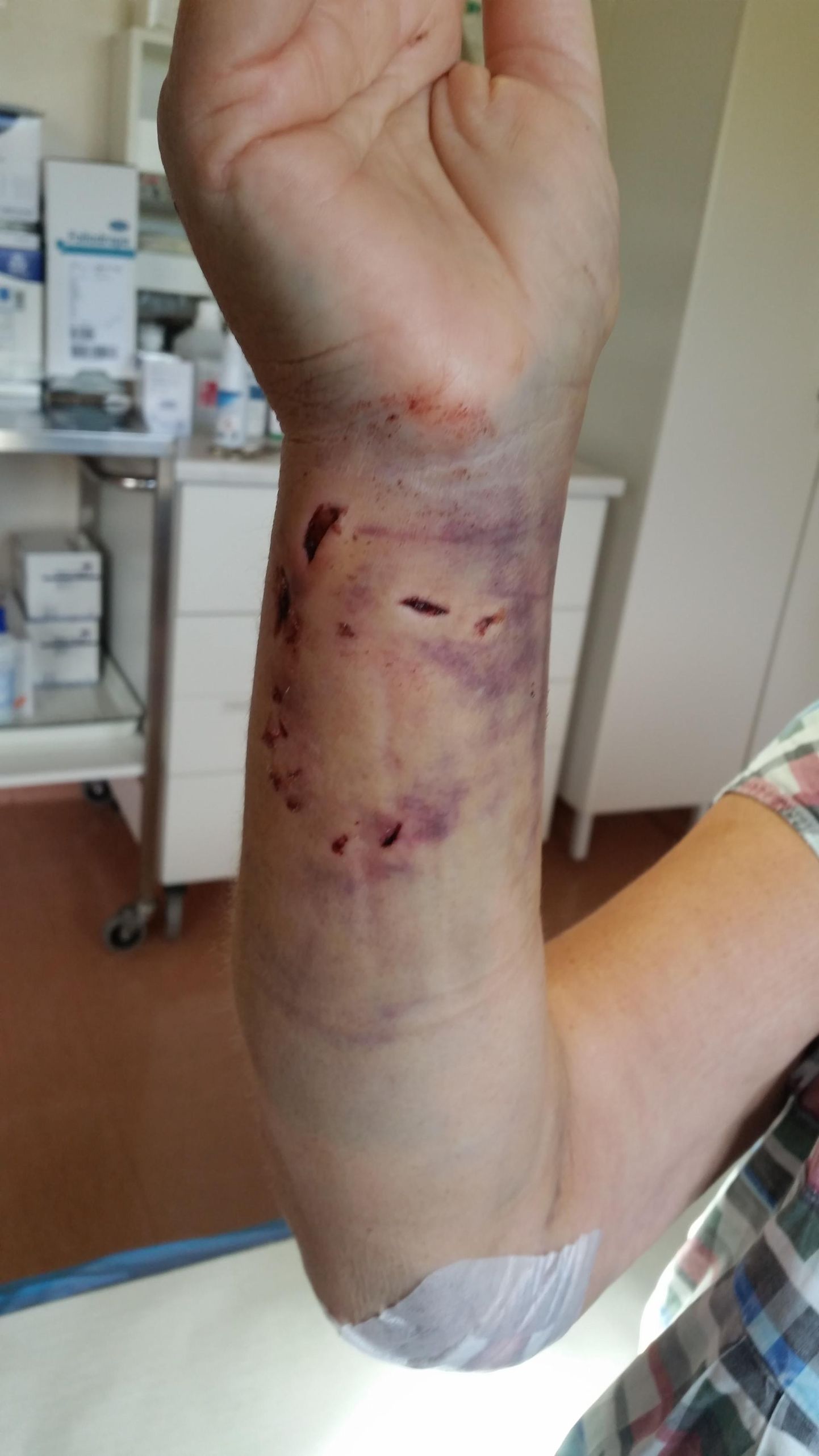 Viga saanud naise murtud luuga käsi pandi viieks nädalaks kipsi ja nädal tuli tal veeta haiglas. Koerad rahunesid siis, kui naine istuli kukkus.